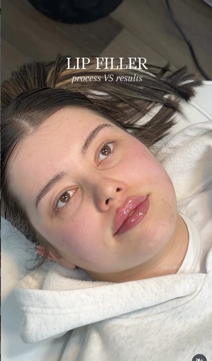 JSK Aesthetics reel — lip filler process vs results