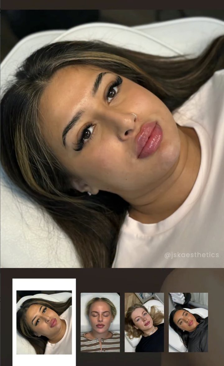 JSK Aesthetics reel — lip filler results