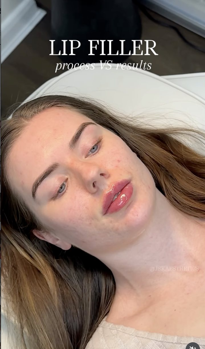 JSK Aesthetics reel — lip filler process